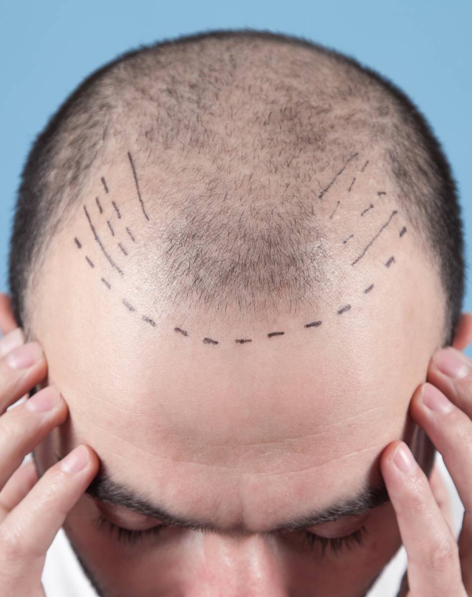 Résultats et prix greffe de cheveux à Lyon