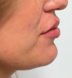 prix injection acide hyaluronique avant après