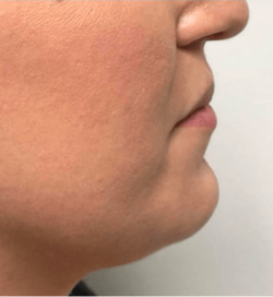 injection acide hyaluronique avant après