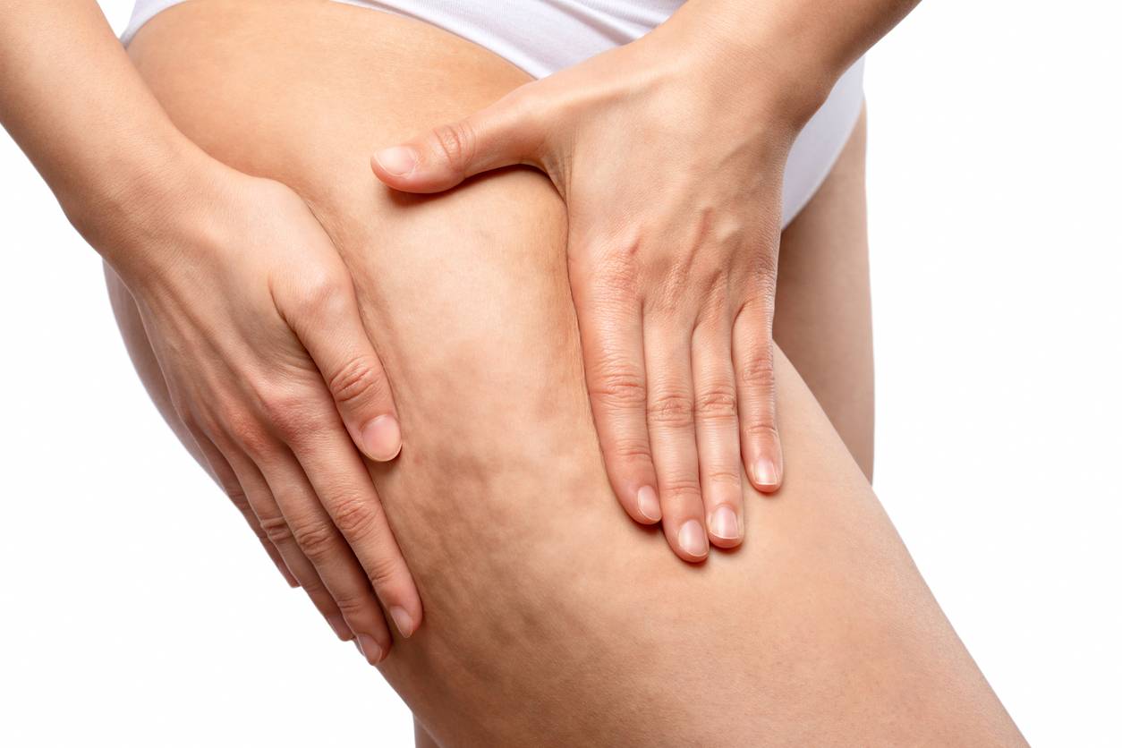 Lutter contre la cellulite